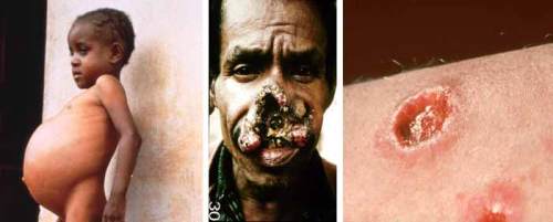 leishmania clin appearance